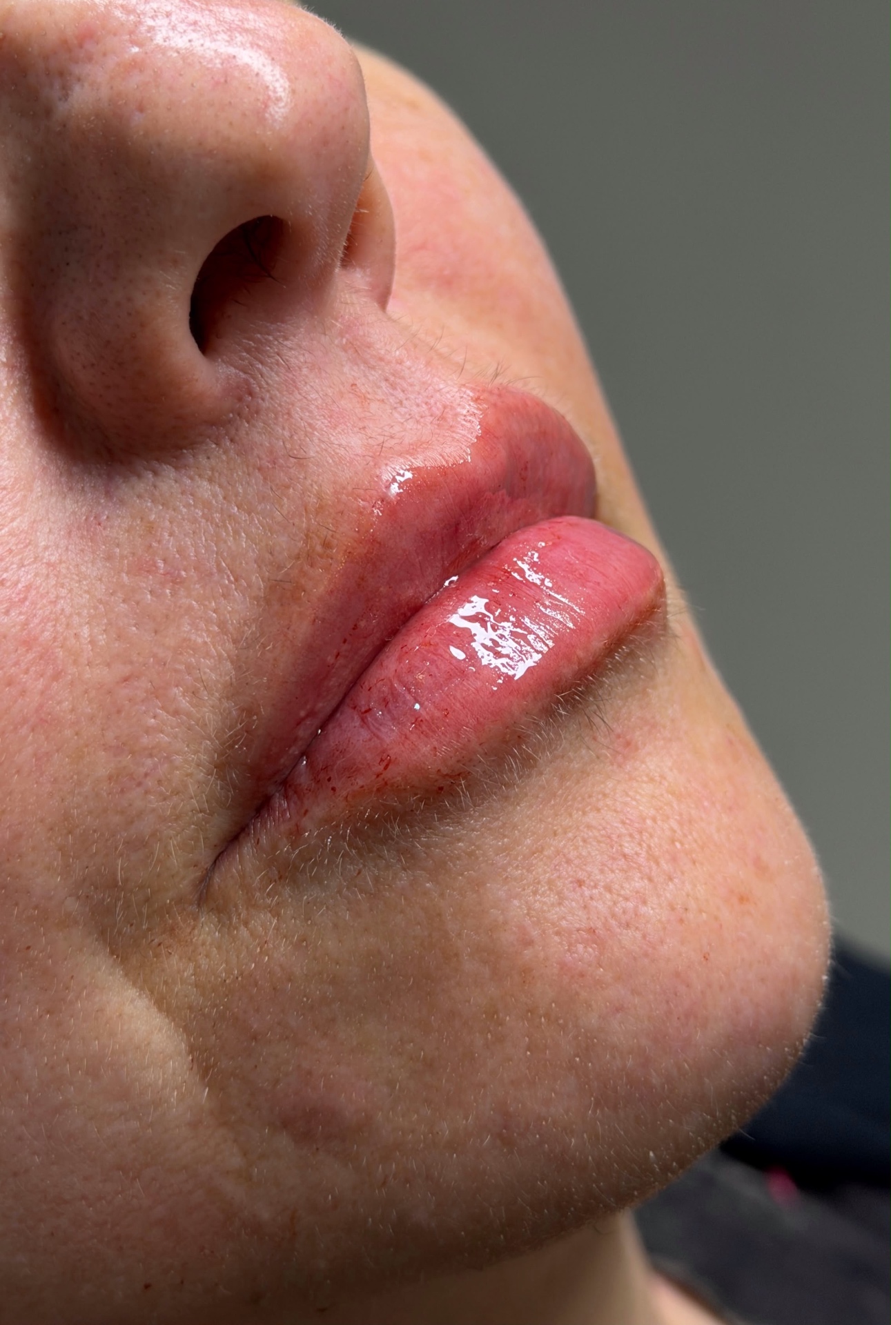 Preenchimento labial · volume equilibrado