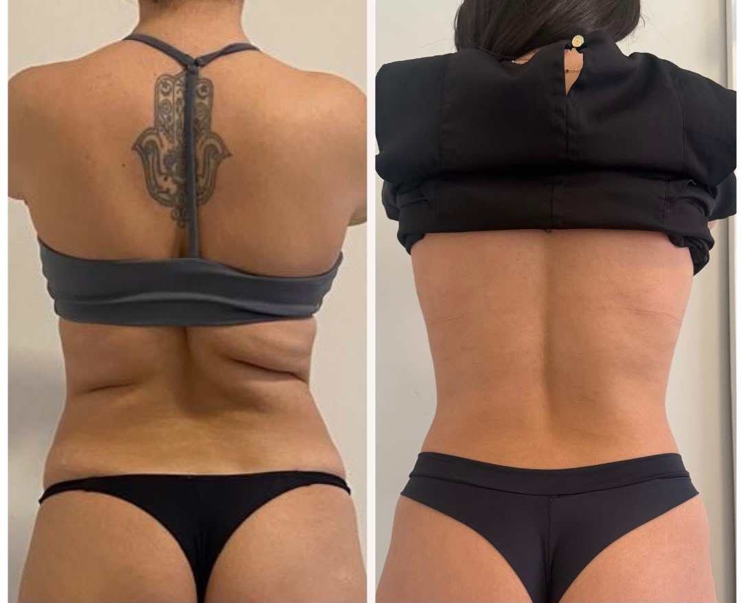 Estética corporal · antes e depois