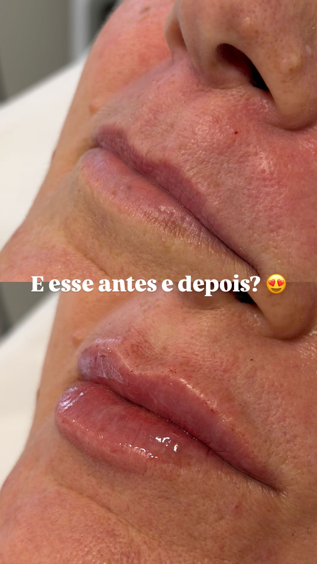 Contorno labial · definição suave