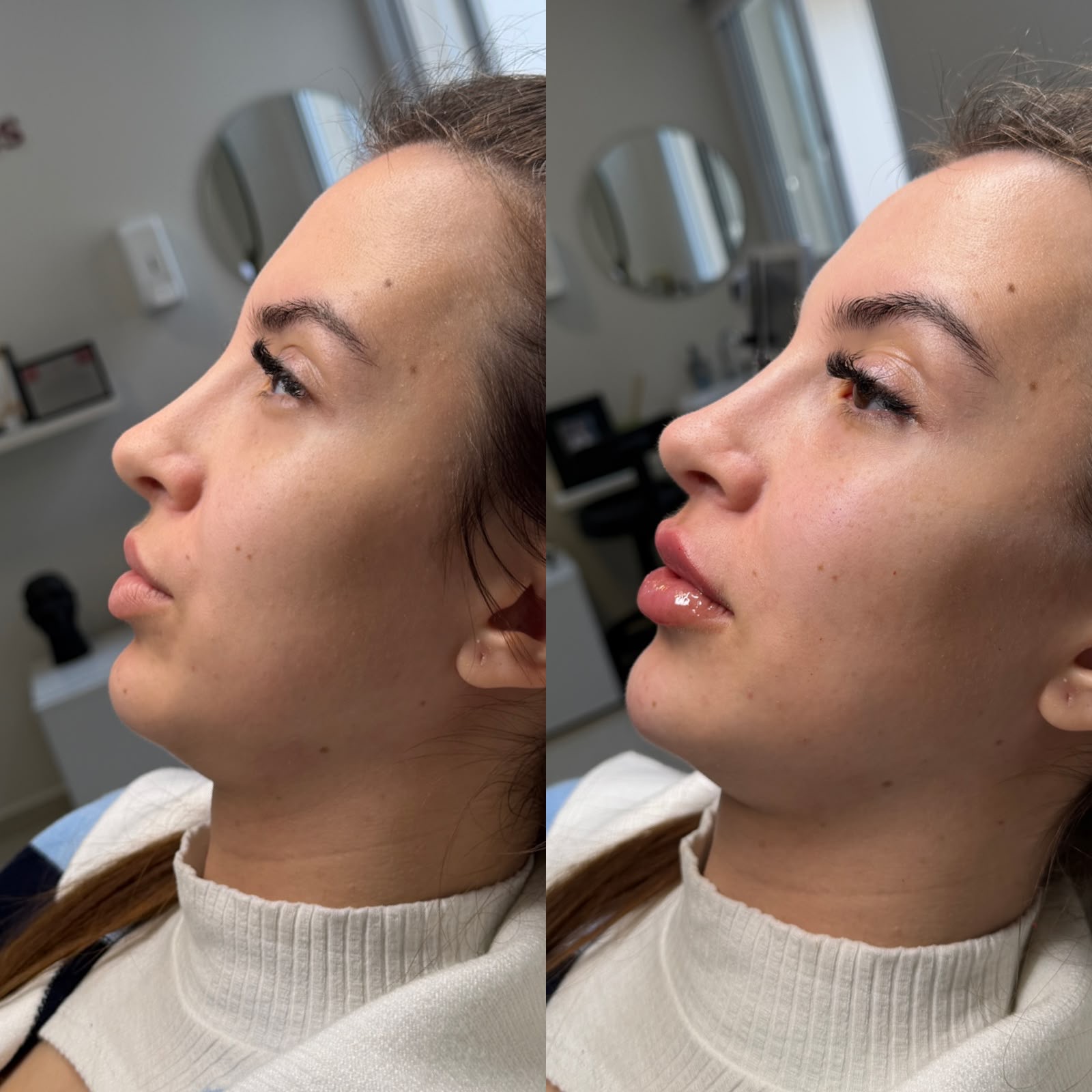 Harmonização de perfil · antes e depois