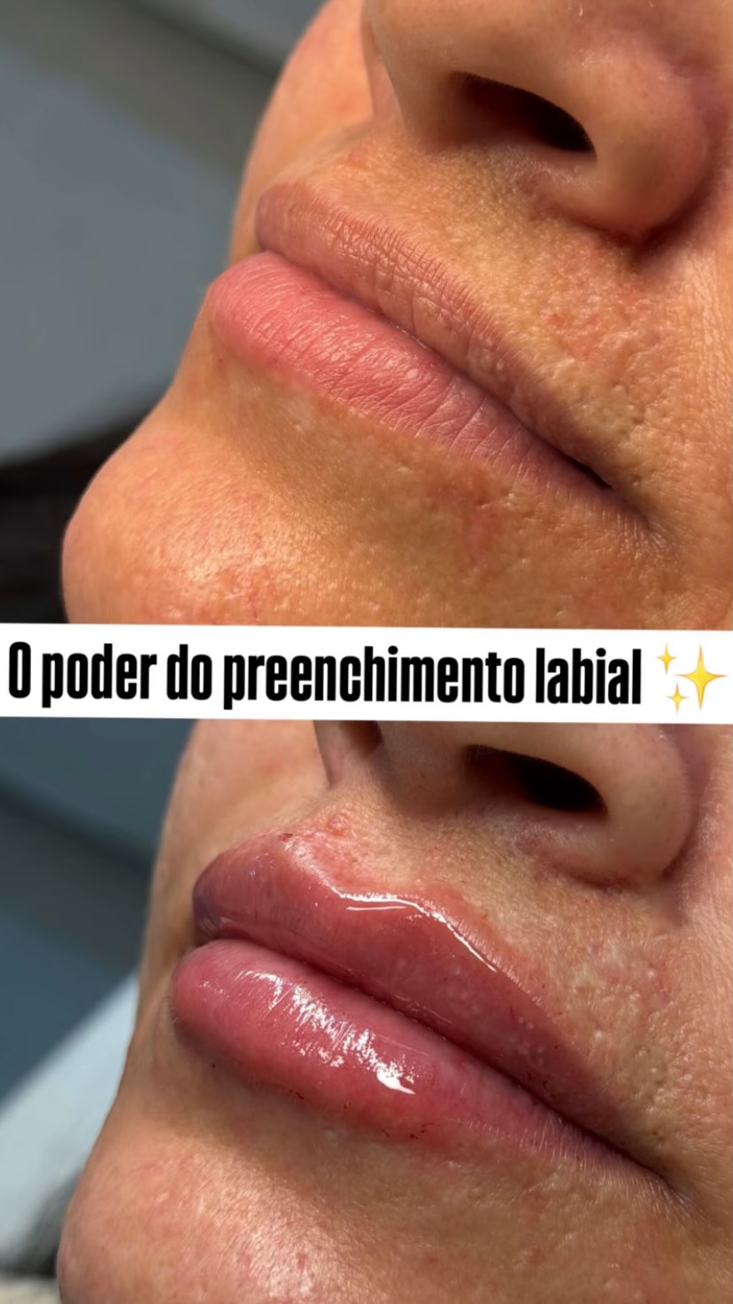 Preenchimento labial · antes e depois