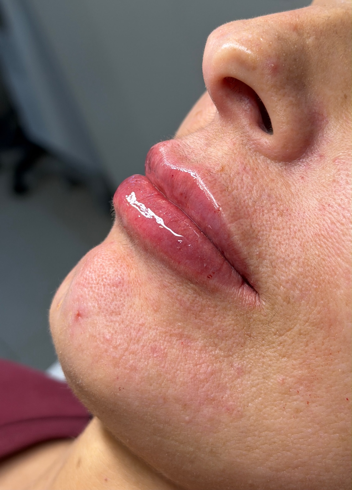 Volumização labial · resultado harmônico