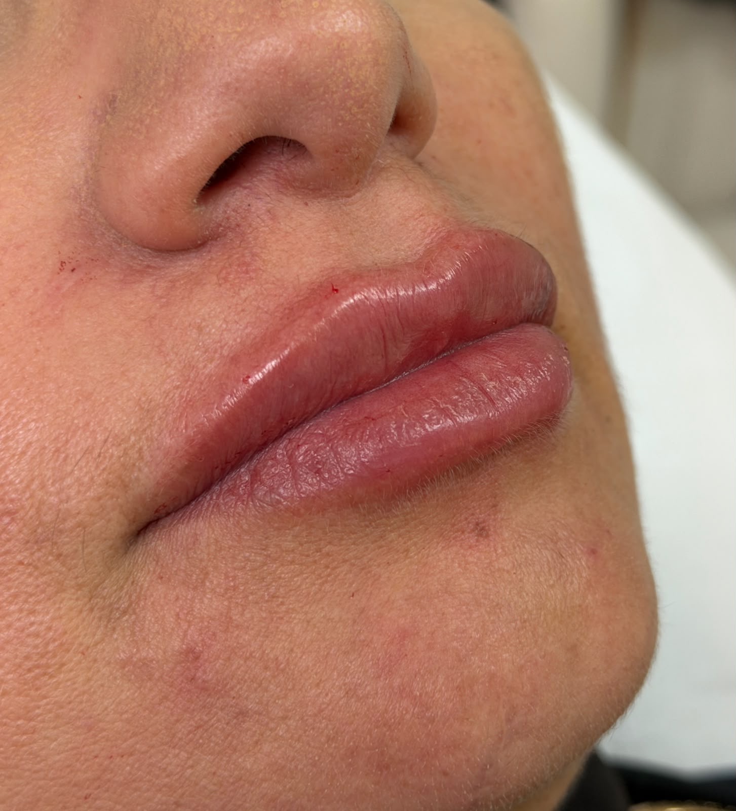 Preenchimento labial · acabamento natural