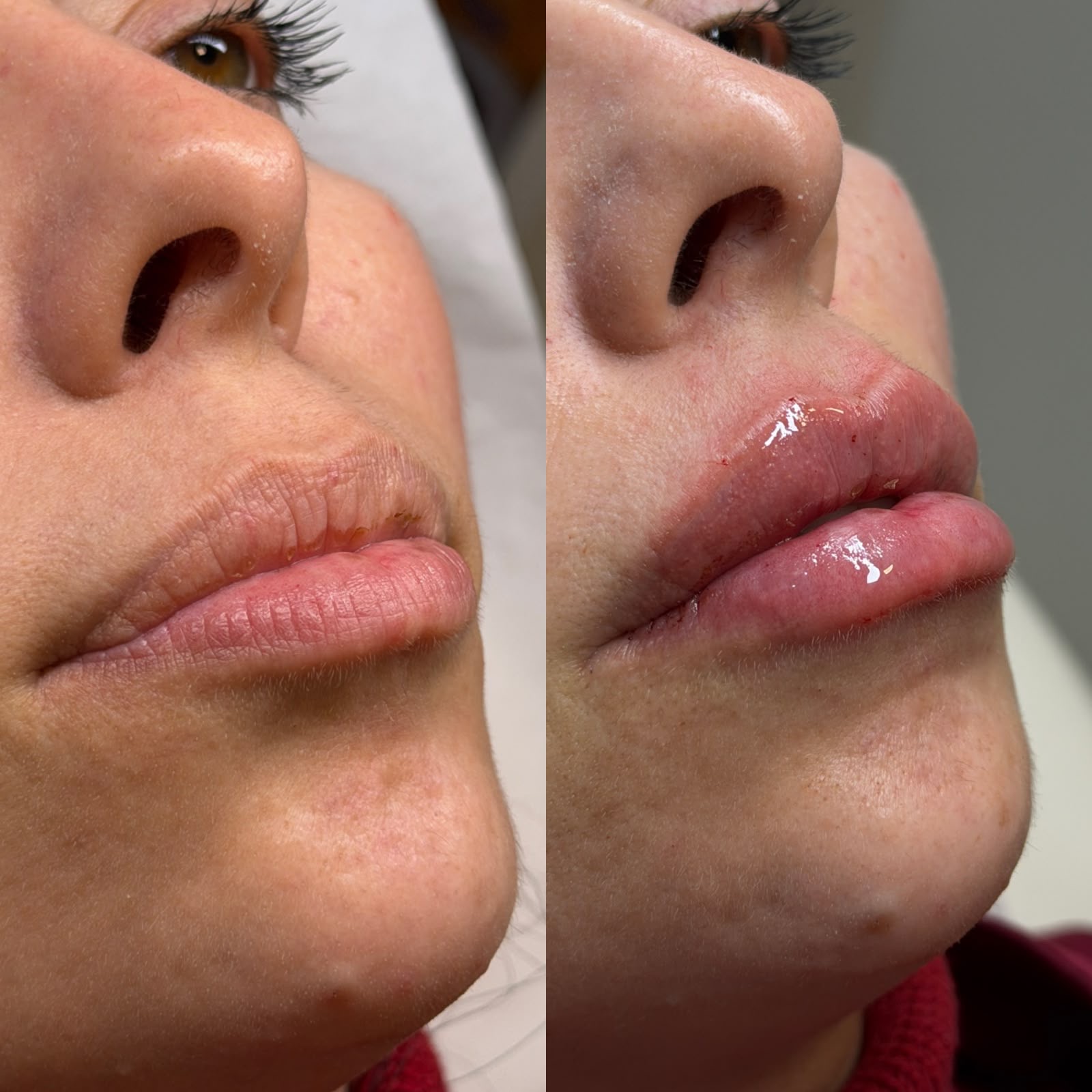 Preenchimento labial · antes e depois