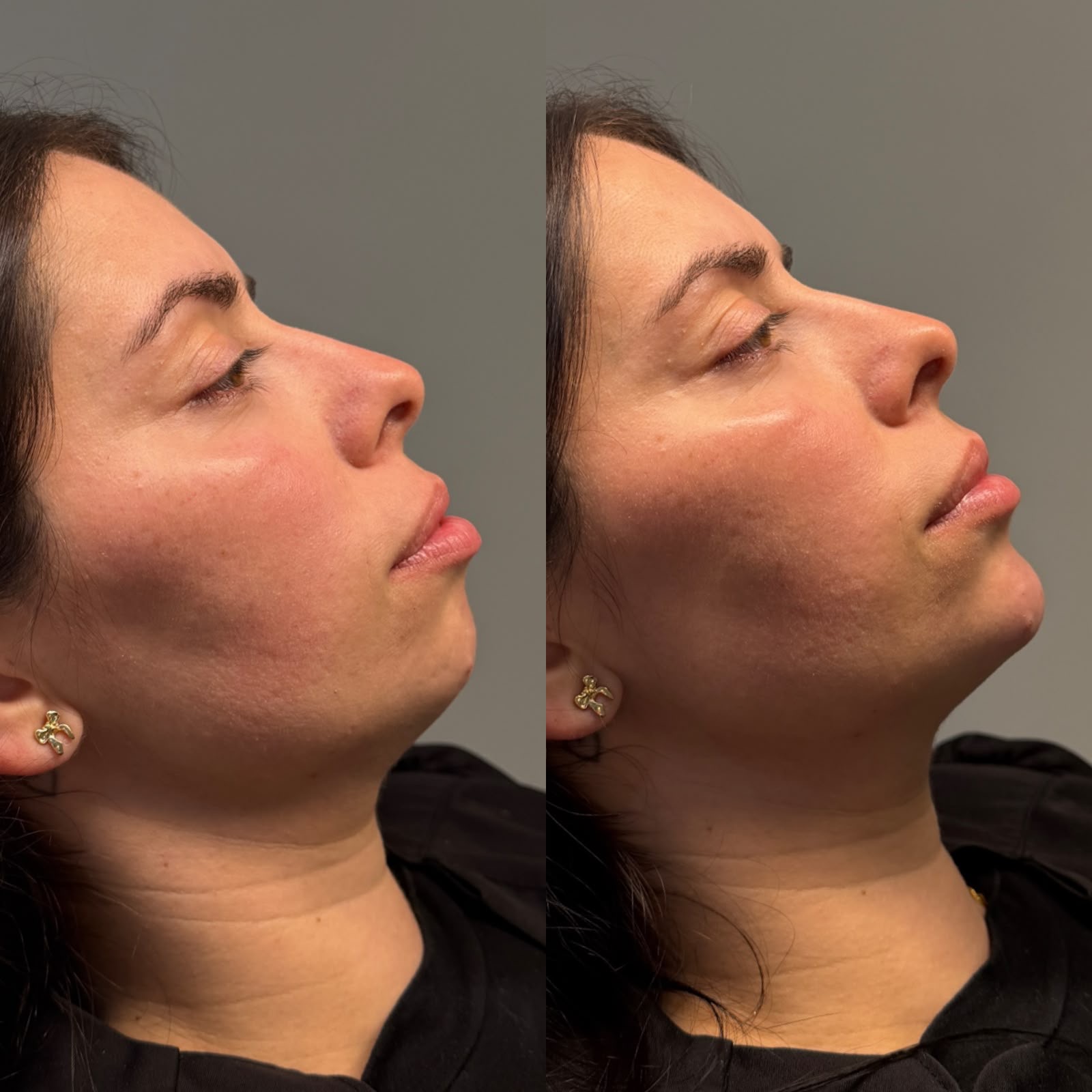 Contorno mandibular · antes e depois